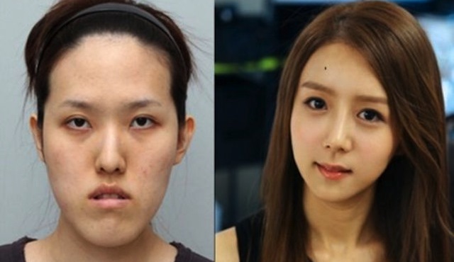 South Koreans Before And After Plastic Surgery Korean Vrogue Co