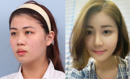 Crazy Before And After Photos Of South Korean Plastic Surgery Page 3 