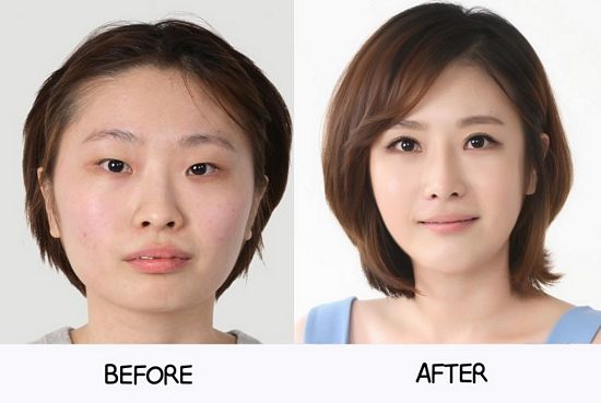 Crazy Before And After Photos Of South Korean Plastic Surgery Page Sick Chirpse