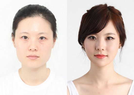 Crazy Before And After Photos Of South Korean Plastic Surgery