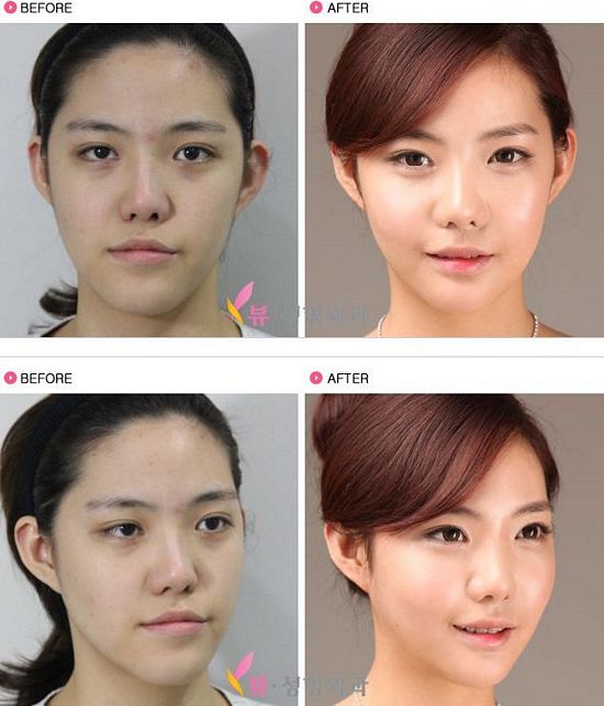 Crazy Before And After Photos Of South Korean Plastic Surgery Page 6 