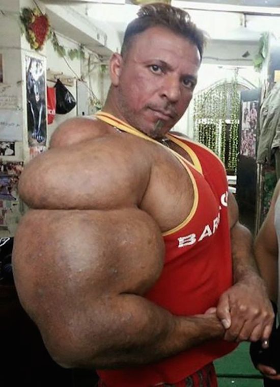 synthol-and-steroid-bodybuilder-5.jpg