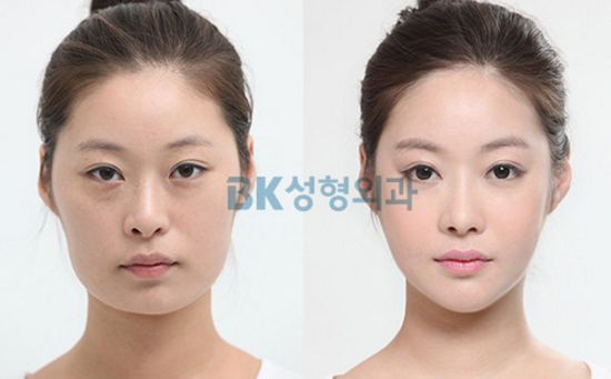 Crazy Before And After Photos Of South Korean Plastic Surgery – Page 4 ...