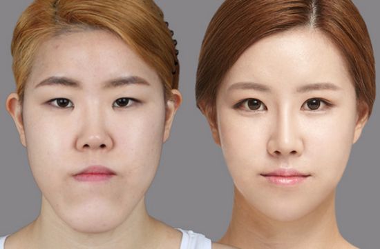 Crazy Before And After Photos Of South Korean Plastic Surgery 