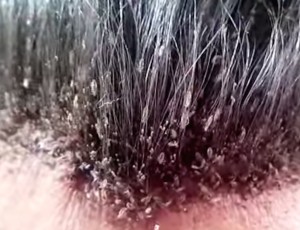 The Man With The World's Worst Head Lice Infestation Is Living An ...